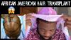 African American Hair Transplant 5 Month Update Black Hair Afro Hair Type 4c Motivation Monday